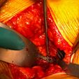 52_surgery.jpeg Cage ALIF- Anterior Lumbar Interbody Fusion (real operation)