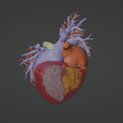 8.png 3D Model of Human Heart with Double Superior Vena Cava (DSVC) - generated from real patient