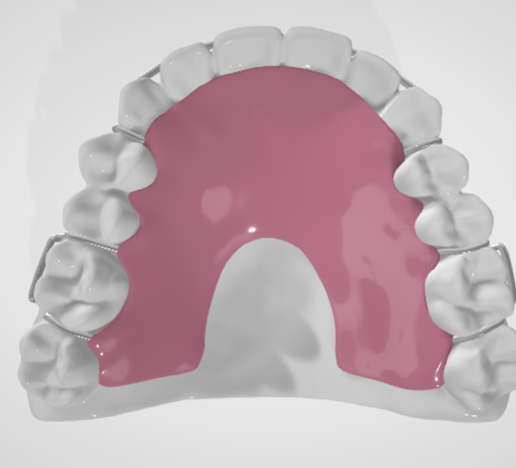 High resolution Standard Hawley Dental Appliance