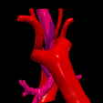 7.png 3D Model of Double Aortic Arch