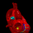 6.png 3D Model of Partial Anomalous Pulmonary Venous Connection
