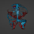 w7.png 3D Model of Brain Arteriovenous Malformation