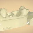 untitled.56.jpg Digital Dental Quadrant  Model with a Full Contour Crown