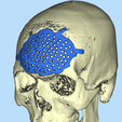 2.png CRANIAL PLATE MADE ACCORDING TO DEFECT