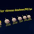 posterior-vitreous-detachment-types-eye-3d-model-blend-55.jpg Posterior vitreous detachment types eye 3D model
