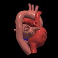 4.jpg 3D Model of Heart with Atrial Septal Defect
