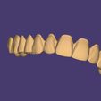 Clipboard-2024-12-21-00-44-14.jpg DIGITAL TOTAL UPPER REMOVABLE DENTURE - 3 stl files (base + teeth + monoblock)