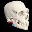 i2.jpg 3D Model of Brain Arteriovenous Malformation