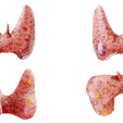 Thyroid_Render.png Tiroides sana y cáncer de tiroides