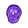 OBJ2 - MCA Aneurysm.obj 3D Model of Middle Cerebral Artery (MCA) Aneurysm