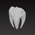 caries2.jpg 龋齿
