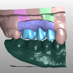 Model_25.png STL file Dental model bridge on implant・3D print design to download