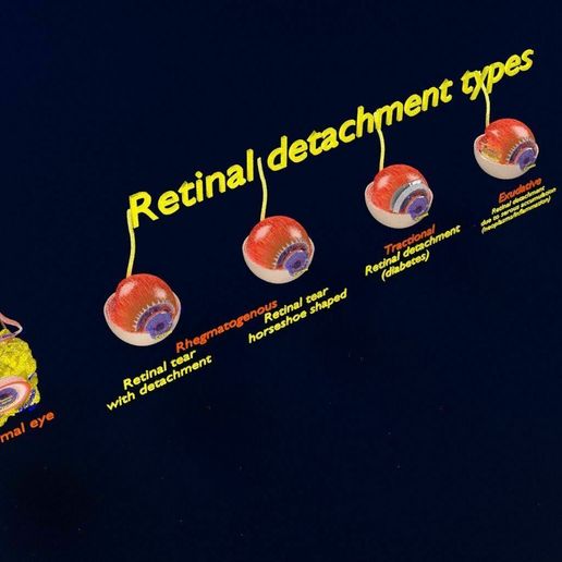 retinal-detachment-types-eye-3d-model-blend-72.jpg Retinal detachment types eye 3D model
