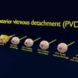 posterior-vitreous-detachment-types-eye-3d-model-blend-85.jpg Posterior vitreous detachment types eye 3D model