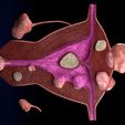 siga.jpg Fibroid Uterus Human female 3D