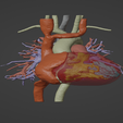 1.png 3D Model of Human Heart with Tetrology of Fallot (TOF) - generated from real patient