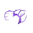 papvcarteries1.stl 3D Model of Partial Anomalous Pulmonary Venous Connection