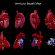 2.VSD.png Congenital Heart Disease - 7pack