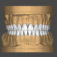 1.png Dental Model (in articulator)