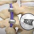 2022-11-01-at-02-36-34.jpg Cage XLIF (Extreme Lateral Interbody Fusion )