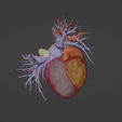 8.png 3D Model of Human Heart with Pulmonary Artery Sling (PAS) - generated from real patient