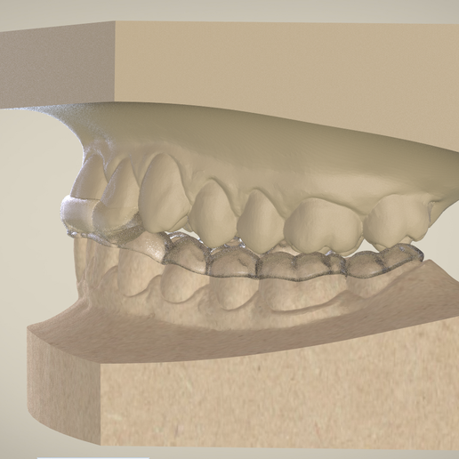 Ortho Superior Repositioner Splint
