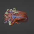 3.png 3D Model of Human Heart with Patent Ductus Arteriosus (PDA) - generated from real patient