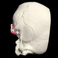 5.jpg 3D Model of Middle Cerebral Artery (MCA) Aneurysm