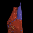 3.png 3D Model of Heart with Transposition of the Great Arteries, long axis view