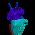9.png 3D Model of Bicuspid Aortic Valve (BAV)
