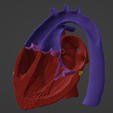6.png 3D Model of Heart with Transposition of the Great Arteries, long axis view