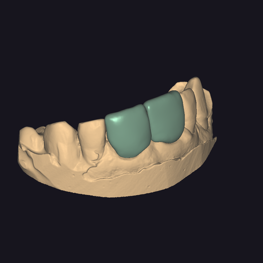 Temporary resin-printed carylae parts 1.1 2.1 3D model