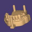 Clipboard-2024-12-21-00-27-39.jpg DIGITAL FLEXIBLE UPPER PARTIAL DENTURE  (3D models !!!) - 7 stl files for download)