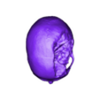 Skull with defect.stl CRANIAL PLATE MADE ACCORDING TO DEFECT