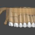 7.png Dental Model (in articulator)