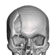 Captura-de-Pantalla-2023-08-22-a-la-s-6.34.24-p. m.png skull fracture / skull fracture