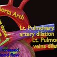 ps-0037.jpg PDA Patent Ductus Arteriosus vs Normal blood circulation