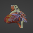 2.png 3D Model of Human Heart with Tetrology of Fallot (TOF) - generated from real patient