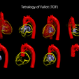 6.TOF.png Congenital Heart Disease - 7pack