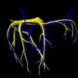 12.png 3D Model of Partial Anomalous Pulmonary Venous Connection