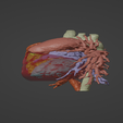 2.png 3D Model of Human Heart with Patent Ductus Arteriosus (PDA) - generated from real patient