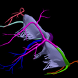 17.png 3D Model of Bicuspid Aortic Valve (BAV)