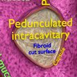 0006.jpg Fibroid Uterus Human female 3D