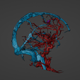 w9.png 3D Model of Brain Arteriovenous Malformation