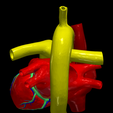 4.png 3D Model of Common Arterial Trunk Truncus Arteriosus