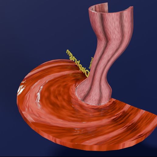 ⚕️ Gastro oesophageal reflux disease・ STL File for 3D printing・Cults