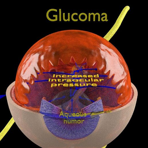 dm11538.jpg Diabetic eye diseases model