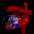 8.png 3D Model of Ventricular Septal Defect