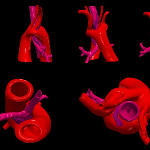 0.jpg 3D Model of Double Aortic Arch