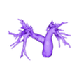 STL00007.stl Modèle 3D de cœur humain avec double arc aortique (DAA) - généré à partir d'un patient réel